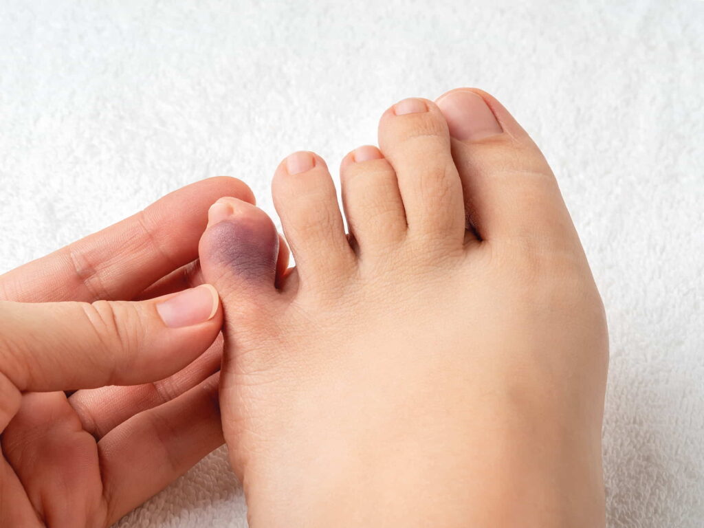 botte e contusioni