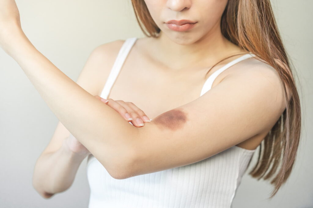 ematoma